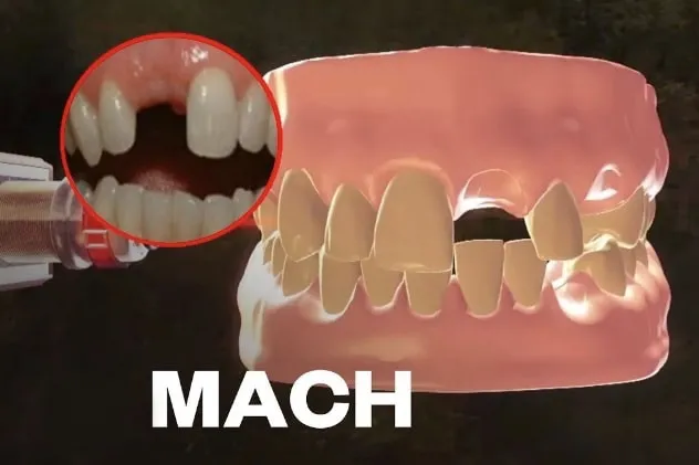 Video: Dentists can now grow new teeth in just a few week