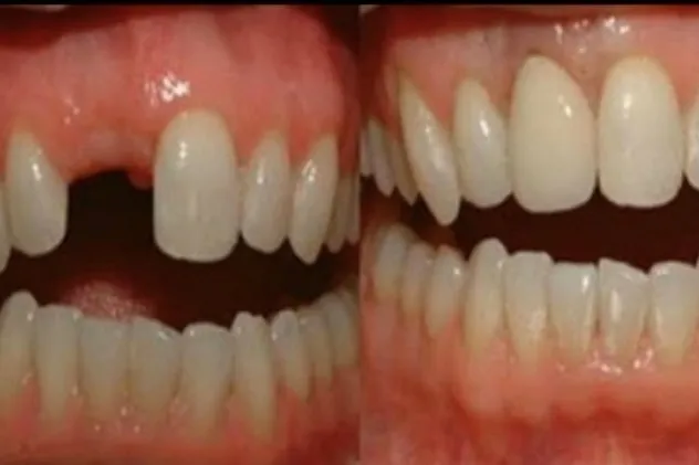 Video: Dentists can now grow new teeth in just a few week